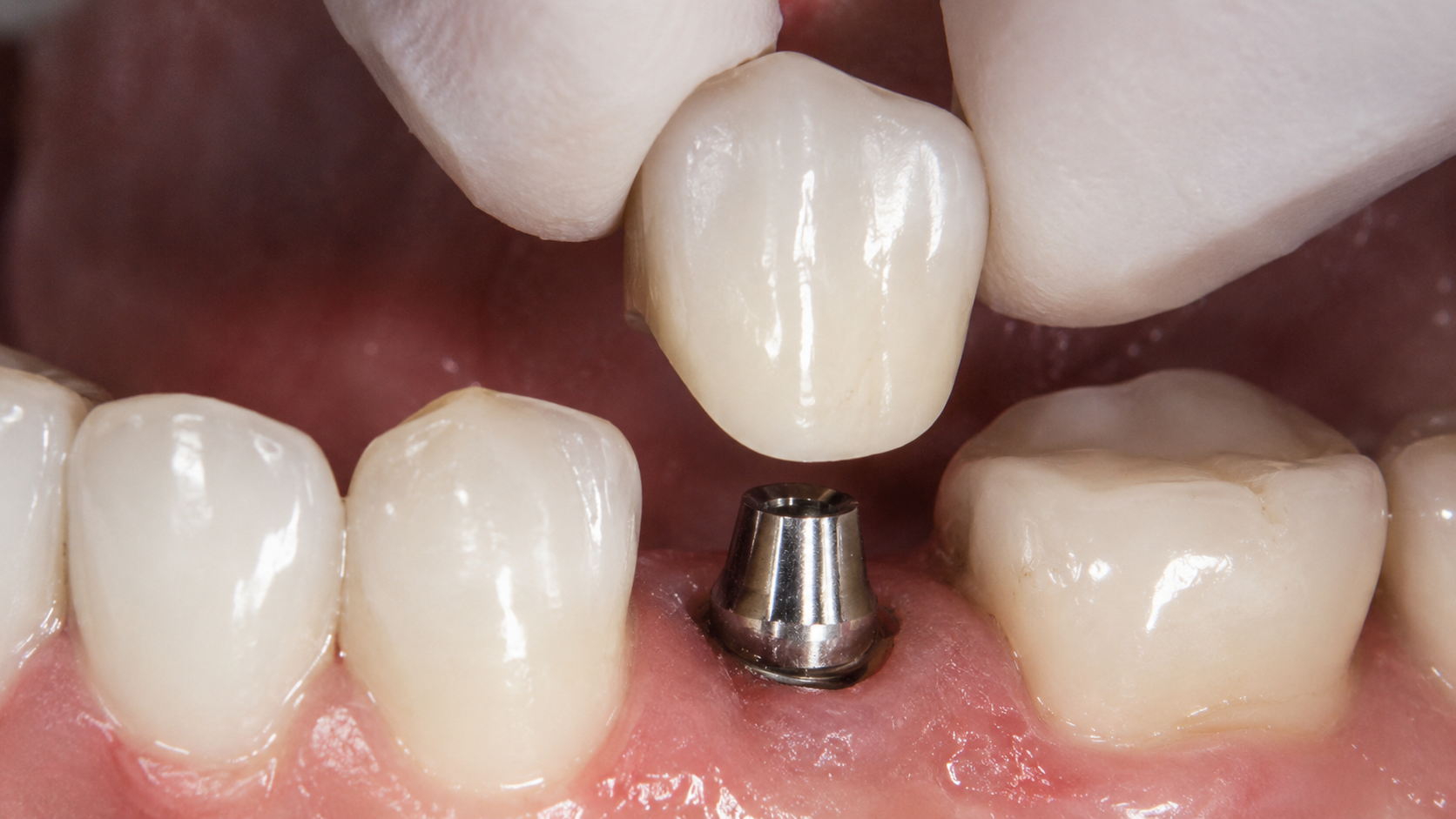 Implante dental unitario