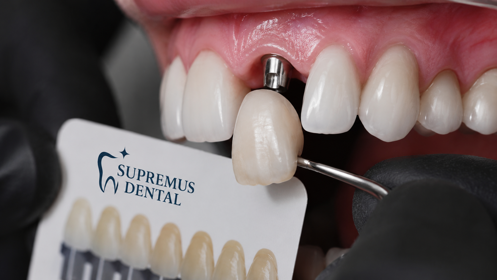 Prótesis sobre implantes