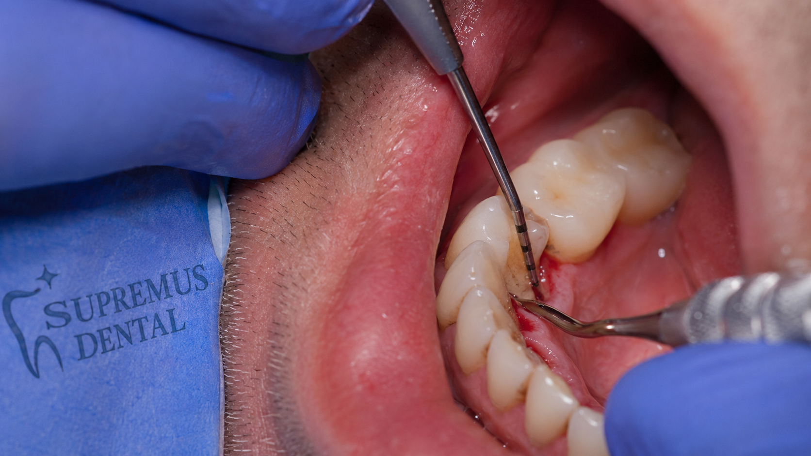 Periodontitis