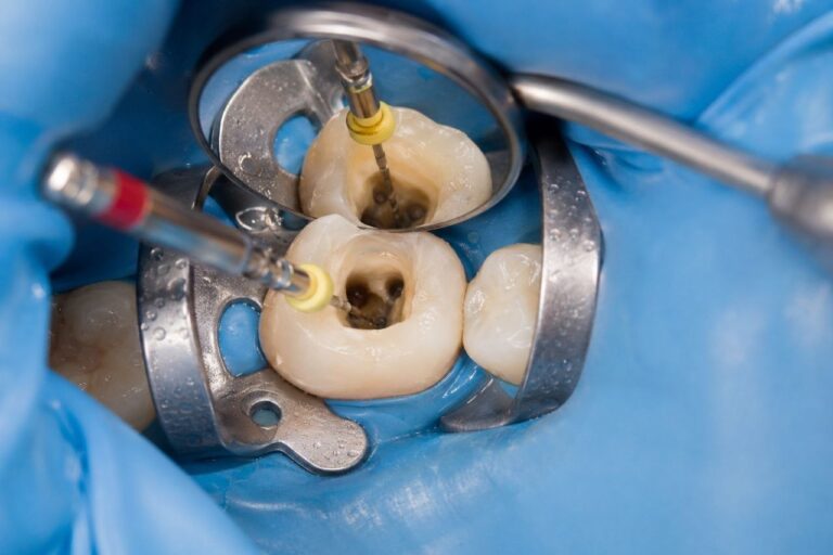 Endodoncia paso a paso: cuándo puede ser necesaria, fases y dudas antes del tratamiento