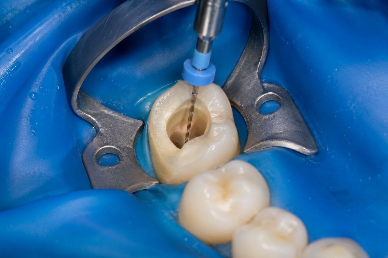 Endodoncia: Cuando se necesita y que esperar.